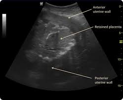 Image result for Retained Placenta