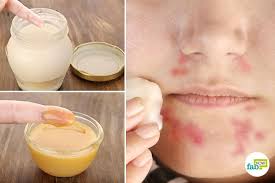 How To Get Rid Of Perioral Dermatitis Heal Rashes With 9 Home Remedies Perioral Dermatitis Perioral Dermatitis