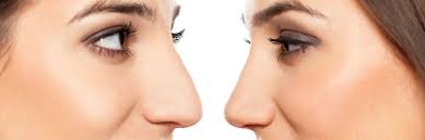 È possibile salvare un massimo di tre backup per backup cloud. Correggere Il Naso Con Acido Ialuronico E Botulino