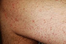 Many of the red, pink, or brown spots you find on your skin are harmless, but some can signal serious skin issues or diseases. This Is How Coronavirus Can Affect Your Skin From Covid Toes To Rashes And Hair Loss Abc News