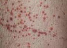 Leucemia mielomonocítica juvenil (jmml) la leucemia mielomonocítica juvenil (jmml) es un tipo poco común de leucemia que no es crónica ni aguda. Atencao As Manchas Vermelhas Na Pele Sbd Fl