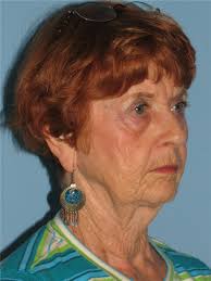 Facelift Before and After Photos by Paul Vanek, MD, FACS; Concord, OH