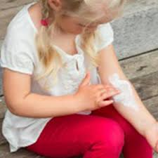 Eczema In Babies And Children Healthychildren Org