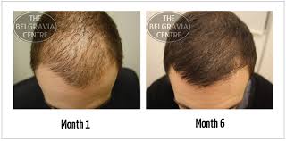 Image result for male pattern baldness