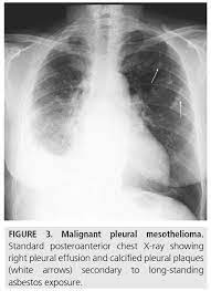 Cytology from the left pleural effusion suggested malignant mesothelioma. Diagnostic Imaging And Workup Of Malignant Pleural Mesothelioma