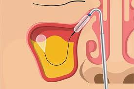 Image result for Sinus Surgery