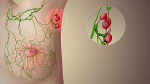 If the lymph nodes feel enlarged, it's likely the breast cancer has spread. Sentinel Lymph Node Wikipedia