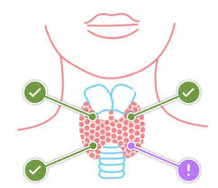 Image result for Hyperparathyroidism