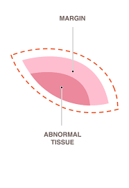 Cervical biopsies can be done in several ways. Biopsy National Breast Cancer Foundation