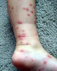Image result for Fire Ant Sting