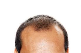 Image result for hair loss pics