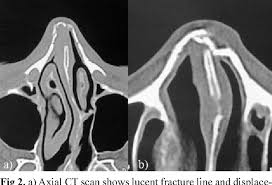 Typically, a nasal fracture is associated with a break of the external nasal bones that then results in cosmetic and functional changes. Pdf Nasal Bone Fracture Ultrasonography Or Computed Tomography Semantic Scholar