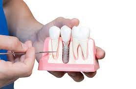 Free government grants for dental implants: BusinessHAB.com