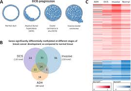 An abnormal growth of cells can arise in the breast lobules or in the breast ducts. Dna Methylation Landscape Of Triple Negative Ductal Carcinoma In Situ Dcis Progressing To The Invasive Stage In Canine Breast Cancer Scientific Reports