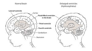 Image result for Hydrocephalus