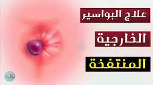 علاج البواسير الخارجية المنتفخة youtube