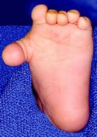 Image result for Polydactyly