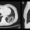 Along with cns cryptococcosis, it is one of the most common fungal opportunistic infections of the central nervous system. 1