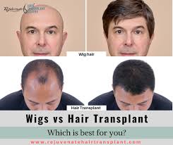 Get 50% off hair extensions! Wigs Vs Hair Transplant Which Is Best For You