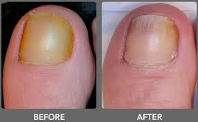 laser nail fungus removal in victoria