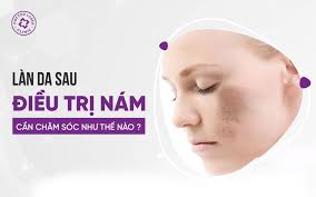 Làn Da Sau Điều Trị Nám Cần Chăm Sóc Thế Nào?