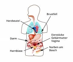 Причины возникновения эндометриоза 2 ursachen der endometriose. Endometriose Ursachen Symptome Behandlung