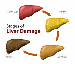 Fatty liver
