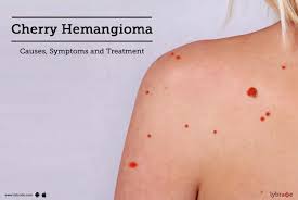 They're typically very small, on average cherry angiomas and liver dysfunction also be related, for a similar reason. Cherry Hemangioma Causes Symptoms And Treatment By Dr Gunjan Shah Lybrate
