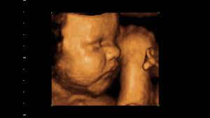 Kosten, risiken und der richtige zeitpunkt während der schwangerschaft werden von deiner krankenkasse routinemäßig drei große ultraschalluntersuchungen übernommen, die vorsorgeuntersuchungen. 3d Ultraschall Baby Kind Schwangerschaft Youtube