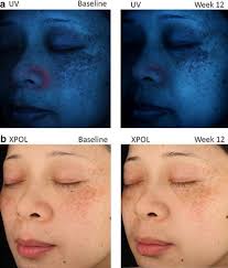 Clinical efficacy and safety of 4-hexyl-1,3-phenylenediol for improving  skin hyperpigmentation