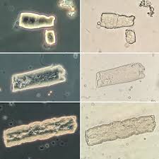 Three Waxy Casts In A Patient With Septic Aki 3 Phase Contrast Bright Field X400 Urinarysediment Urine Nephrology N Microbiology Lab Medical Tech Urinal