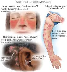 Elakkan aktiviti yang boleh meningkatkan pencemaran udara dalam rumah atau bangunan dengan tidak merokok dan. Penyakit Lupus Atau Sle Penyakit Kronik Sehebat Kanser Yang Ramai Salah Anggap Ianya Penyakit Biasa Siakap Keli News