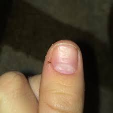 Rillen In Fingernagel Was Dagegen Tun Daumen