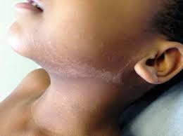 Image result for Postinflammatory Hypopigmentation