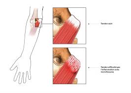 Le tendon long biceps possède un trajet idéal avec 2 points fixes : Epicondylite Paris Clinique Docteur Gilles Cohen