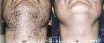 We also offer injectables and fillers such as restylane, dysport, botox, juvederm, and bellafill. Laser Hair Removal Dermatologist Fairfax Virginia Rockville Maryland Washington Dc Dr Hema Sundaram Doctorhema Com