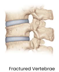 Image result for Vertebral Compression Fracture