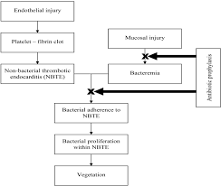 Image result for SBE Prophylaxis