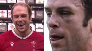 Alun wyn jones is fit to face ireland in wales' six nations opener on sunday, despite a training clash with fellow lock jake ball that left the captain with a black eye. Video Alun Wyn Jones Laughs When Asked If He Forgives Teammate Who Punched Him In The Face