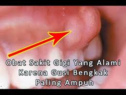 Check spelling or type a new query. Obat Sakit Gigi Karena Gusi Bengkak Paling Ampuh Youtube