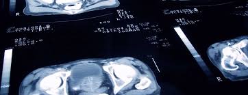 These tips come from if you're feeling stressed, it might help if you talk to other men living with advanced prostate cancer. What Is Individualized Prostate Cancer Care Johns Hopkins Medicine