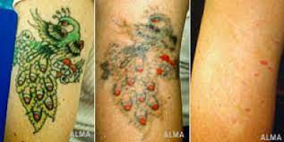 Laser tattoo removal is an advanced treatment designed to completely eliminate tattoos, without leaving scars or depigmented areas of skin behind. Tattoo Removal Green Ink Home Methods For Tattoo Removal