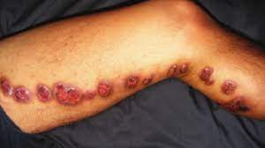 More rarely, cats or armadillos can transmit the disease. Sporotrichosis Treatment Pictures And Rash