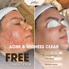 help, I'm losing hope about getting out my acne's ☹️☹️ what advise you  recommend pls?