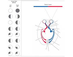 Image result for Visual Field Deficit
