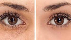 Beras yang dihaluskan bersama kencur dapat dijadikan sebagai cara menghilangkan dark circle yang sudah puluhan tahun digunakan oleh wanita indonesia yaitu dalam bentuk bedak dingin. 7 Cara Menghilangkan Dark Circle Di Bawah Mata Kedai Vitamin Butterworth