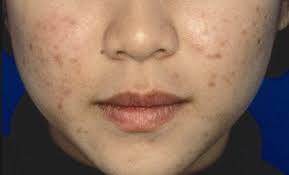 Jika ingin menghilangkan jerawat dalam waktu yang cepat, maka cara menghilangkan jerawat dengan es batu bisa menjadi solusinya. Cara Menghilangkan Bekas Jerawat Batu Dan Jerawat Biasa Klik Enter