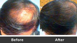 Eugenix is a leading hair clinic chain for male hair transplantation services in india. Hair Transplant In India In Defence Colony New Delhi Id 19954130948