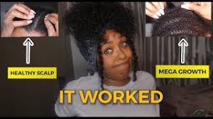 Reviews, before and after pictures. I Put Monistat 7 On My Hair For A Month This Is What Happened No More Dandruff Or Psoriasis Youtube