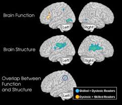 Does this mean that dyslexia is caused by a neurological dysfunction or is there an alternative interpretation that explains. Functional Mri Helps Reveal Brain Abnormalities In Dyslexia As We Go To Press Mar 2007 Biophotonics